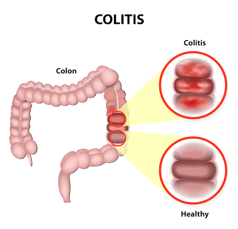CROHN'S DISEASE TREATMENT Assuta